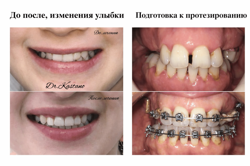 Примеры работ Евгении Бернардовны Кастаньо — изменение улыбки и подготовка к протезированию Примеры работ врача-ортодонта Евгении Бернардовны Кастаньо: изменение улыбки до и после лечения и подготовка к протезированию с помощью ортодонтической коррекции